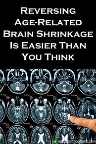 Image result for Shrinking of Brain in Late Aduldhood