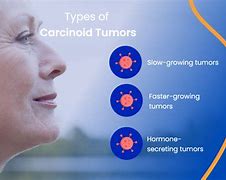 Image result for Carcinoid Tumor Treatment