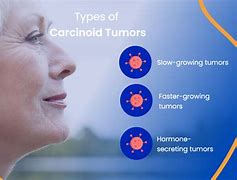 Image result for Cure for Carcinoid Tumor