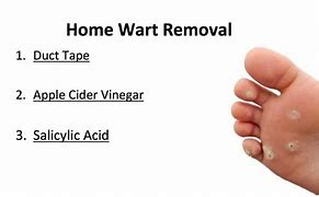 Image result for Wart Removal at Home