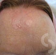 Image result for Basal Cell Carcinoma On Forehead