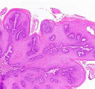 Image result for HPV Under Tongue