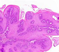 Image result for Vocal Cord Papilloma