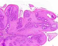 Image result for Laryngeal Squamous Cell Papilloma