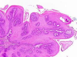 Image result for Squamous Papilloma Nose