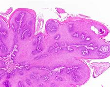Image result for Papilloma
