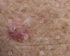 Image result for Skin Cancer Leg