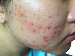 Image result for Common Skin Diseases