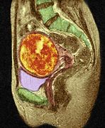 Image result for 19 Cm Fibroid