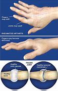 Image result for Arm Joint Snap