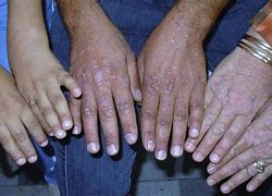 Image result for Mild Epidermodysplasia Verruciformis Genetic