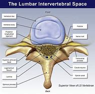 Image result for intervedtebral