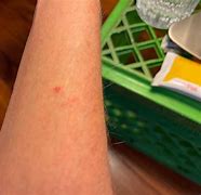 Image result for How Does Scabies Look Like