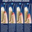 Image result for Gingival and Periodontal Pocket