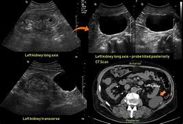 Image result for Renal Cyst Radiology
