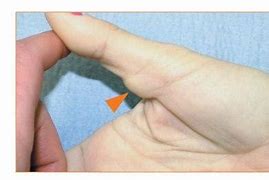 Image result for Giant Cell Tumor Thumb