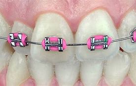 Image result for Pink Braces Girl