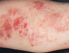 Image result for Adult Eczema On Arms