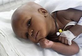 Image result for Baby Born with Hydrocephalus