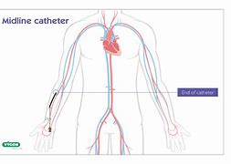 Image result for Midline Catheter Placement