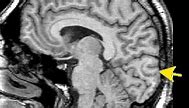 Image result for Whole Brain Atlas