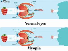 Image result for Myopia Symptoms