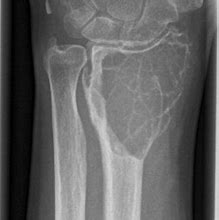 Image result for Tumor in Wrist X-ray