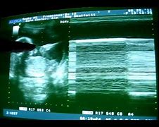 Image result for Sinister Ovarian Cyst Ultrasound