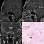Image result for Tumor On Pituitary Gland