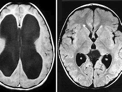 Image result for Hydrocephalus MRI Brain