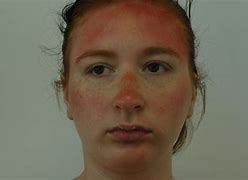 Image result for World Record Sun Burn