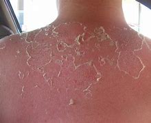Image result for bad sunburn blisters