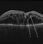 Image result for Retinal Cyst Oct