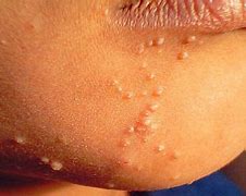 Image result for Molluscum Contagiosum Kid Face