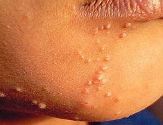 Image result for Molluscum Contagiosum On Face