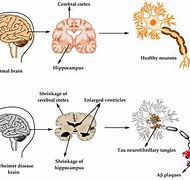 Image result for Brain with Alzheimer's Disease
