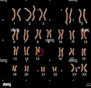 Image result for Chromosome 15 Disorder