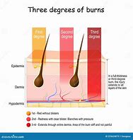 Image result for 3rd Degree Burn Diagram