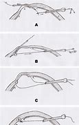 Image result for Laparoscopic Hook Scissors