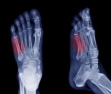 Image result for Jones Fracture Swelling