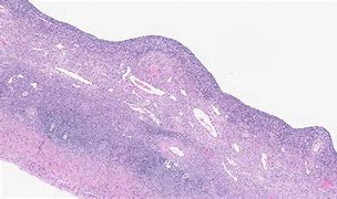 Image result for Cystic Follicle