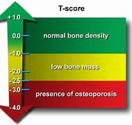 Image result for Osteoporosis Bone Density Chart