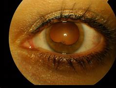 Image result for Posterior Synechiae Iris