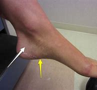Image result for Broken Heel Foot