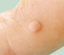 Image result for Genital Warts On Hands
