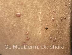 Image result for Molluscum Contagiosum On Dark Skin