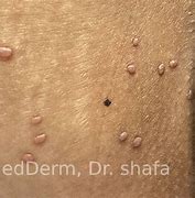 Image result for Molluscum Contagiosum Black Skin