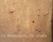 Image result for Cryotherapy for Molluscum Contagiosum