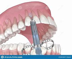 Image result for Dental Anesthesia Cartoon