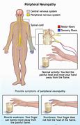 Image result for Peripheral Neuralgia